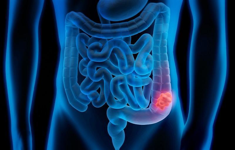 hydrokolonoterapia